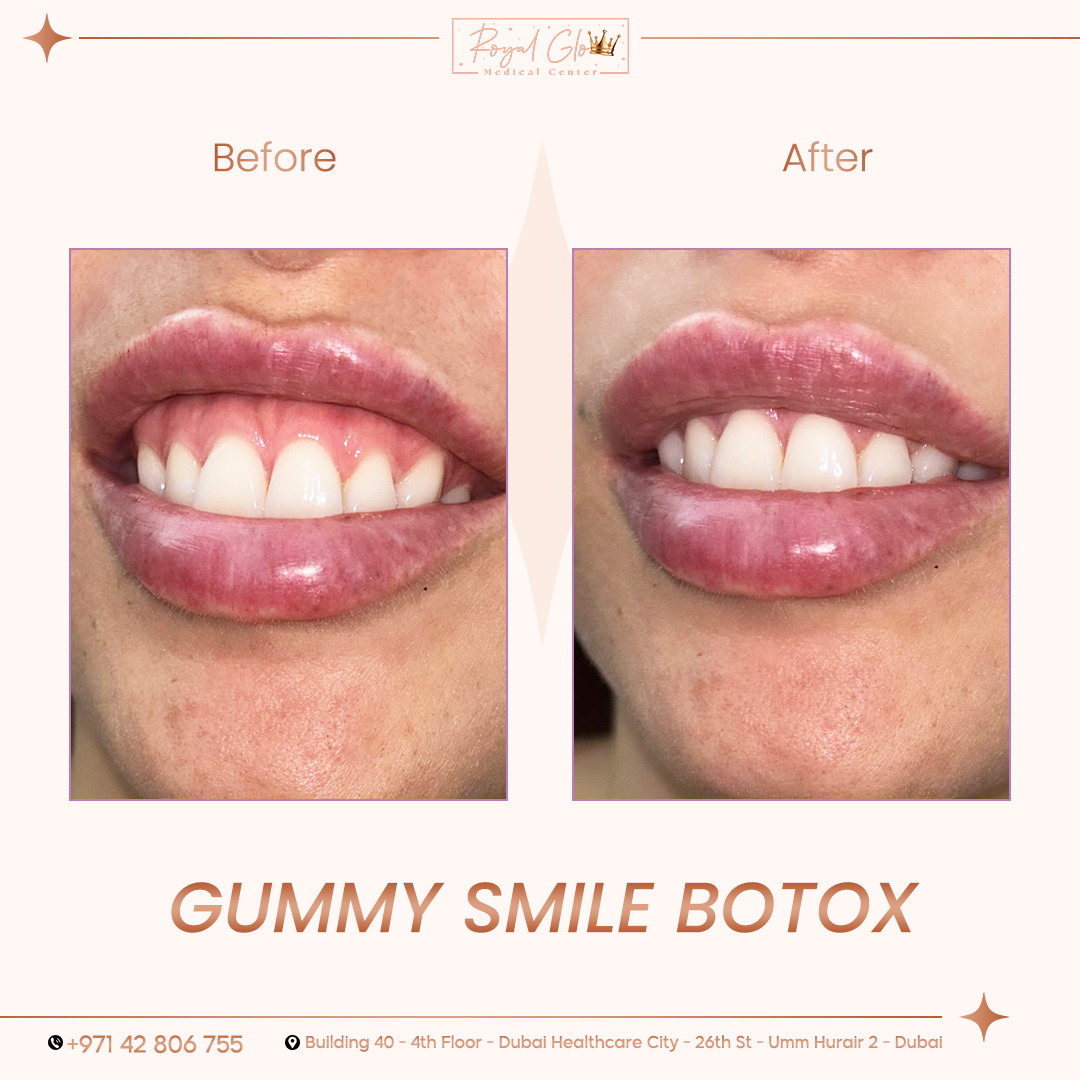 before and after(RG) (8)